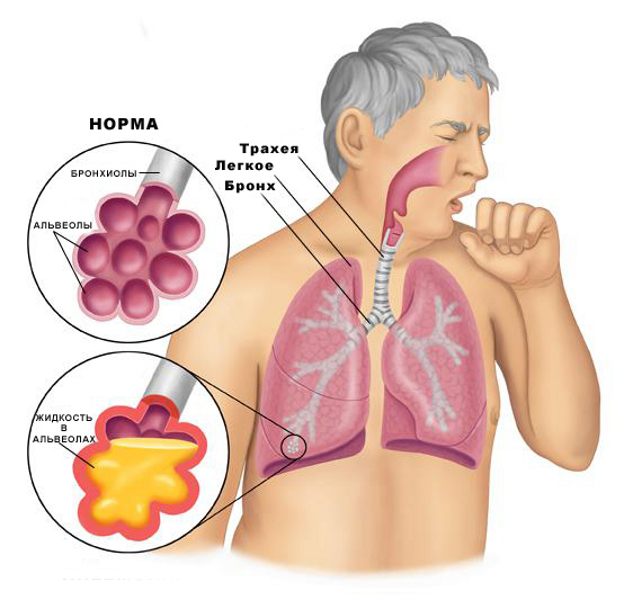 Причины мокроты: без кашля, с кашлем, в горле, с кровью1