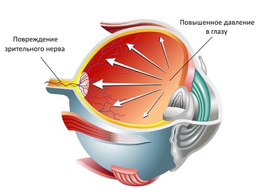 Глаукома: причины и проявления1