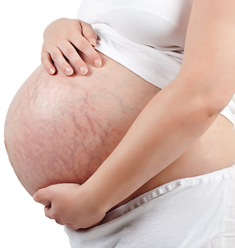 Растяжки после беременности: как избавиться? 1