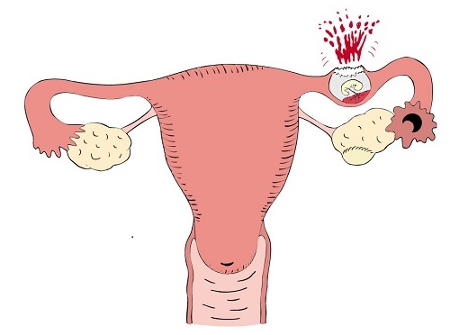 Признаки внематочной беременности1