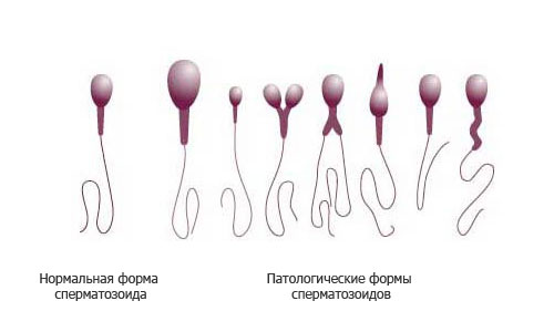 Нарушение морфологии спермограммы: причины1