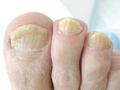 Грибок ногтей: причины, симптомы, лечение1