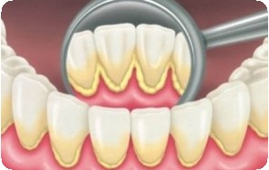 Зубной налет и зубной камень: как убрать1