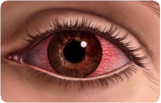 Ожог глаз: сваркой, химический ожог. Первая помощь при ожоге глаза1