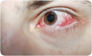 Ожог глаз кварцевой лампой: симптомы, лечение1