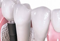 Выбор материала для зубного имплантата