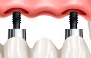 Имплантат верхнего  зуба