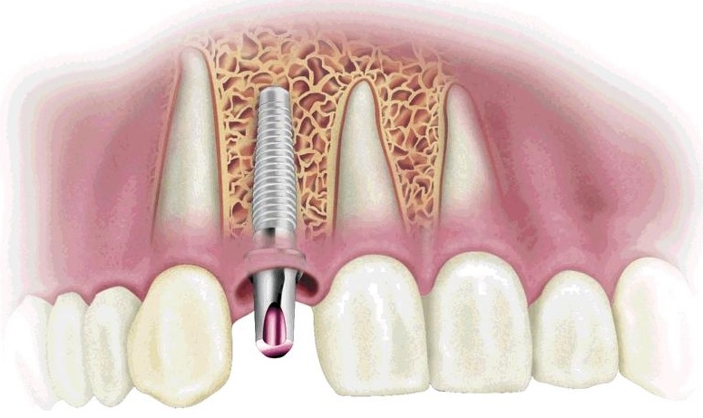 Имплантаты, соединенные с зубами2