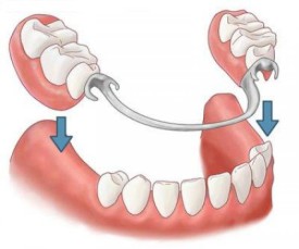 Перекрывающие зубные протезы2