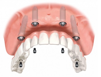 Восстановление всех зубов верхней челюсти2