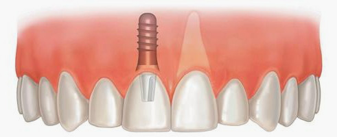Выбор материала для зубного имплантата2