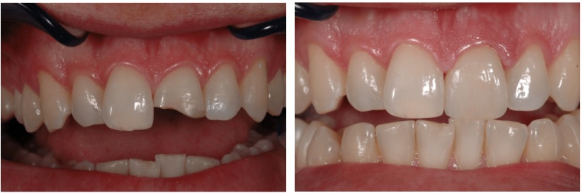 Особенности восстановления передних зубов2