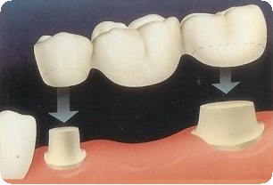 Замещение одиночных зубов2