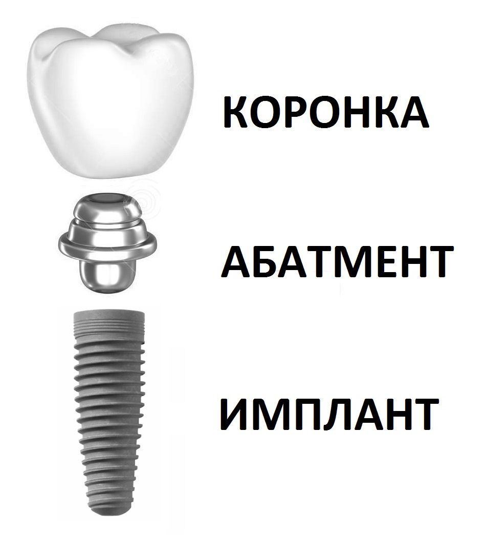 Имплантат верхнего  зуба2