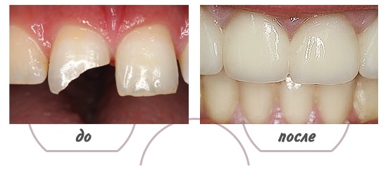 Восстановление переднего зуба2