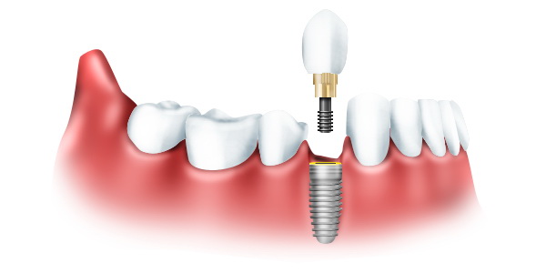 Осложнения при имплантации зубов верхней челюсти2