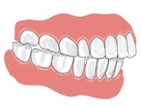 Окклюзия зубных протезов2