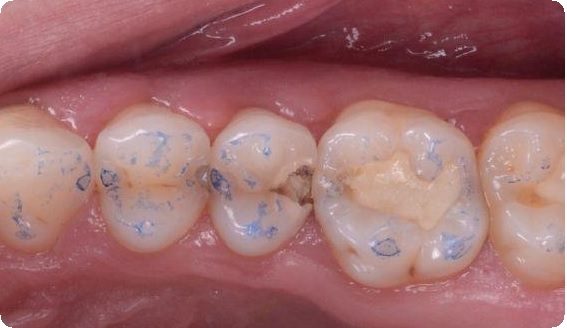 Протокол реставрации зубов2