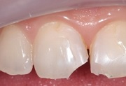 Восстановление переднего зуба