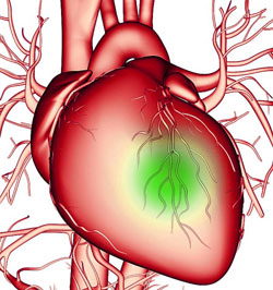 Диагностическая катетеризация сердца2