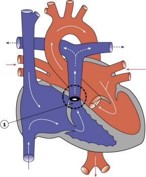 Периферический стеноз легочной артерии2