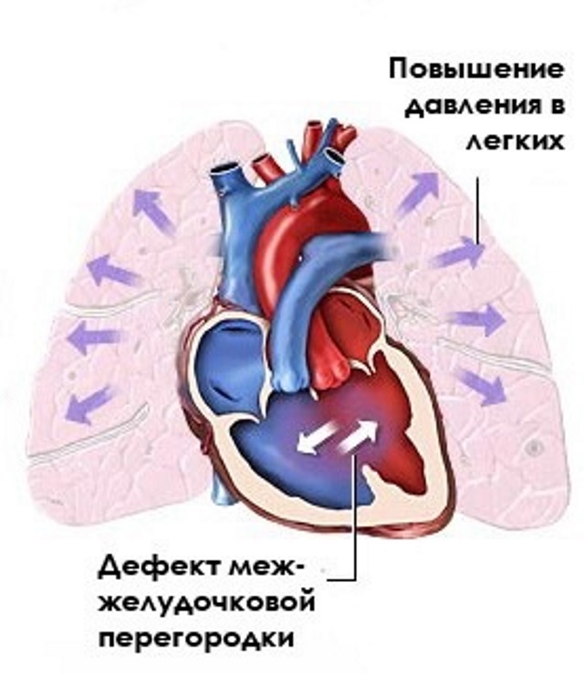 Первичная легочная артериальная гипертензия2