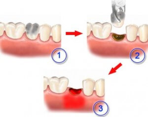 Осложнения после удаления зуба2