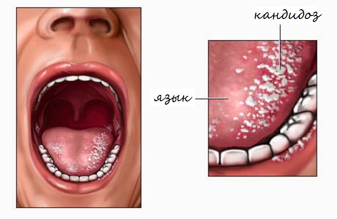 Кандидоз полости рта: симптомы, лечение2
