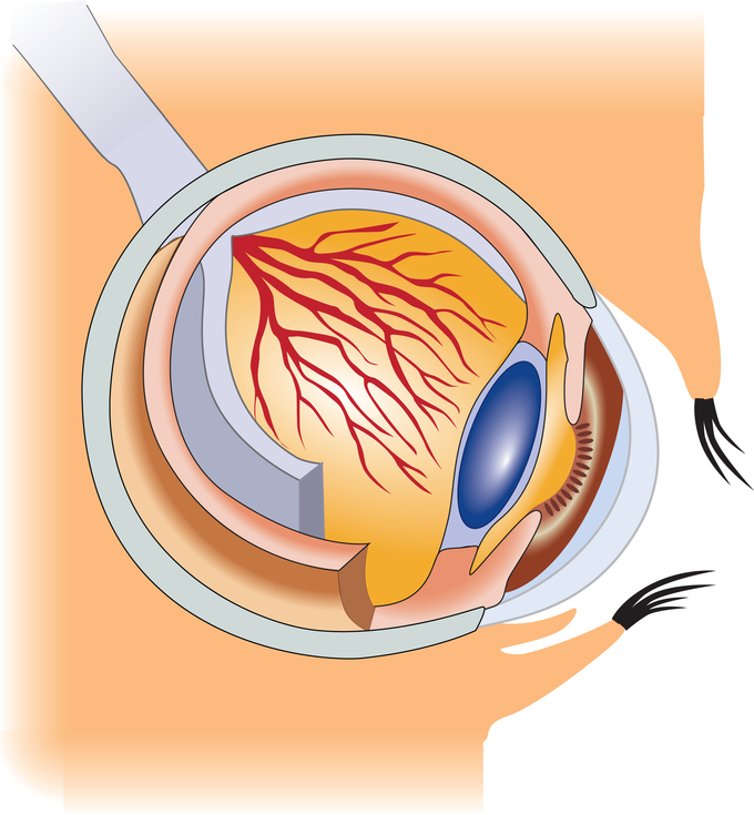 Глаукома: причины и проявления2