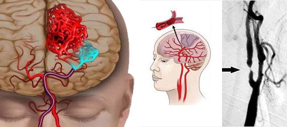 Ишемия головного мозга у новорожденных. Причины, последствия. 2