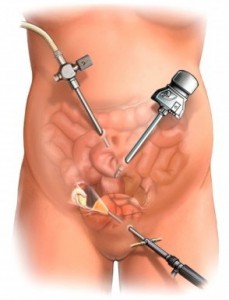 Лапароскопия маточных труб: показания, после операции2