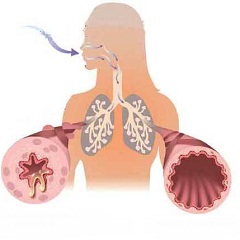 Обструкция верхних дыхательных путей2