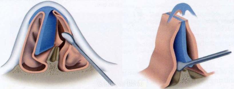 Искривление носовой перегородки: лечение, операция2