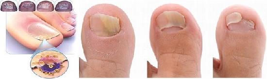 Грибок ногтей: причины, симптомы, лечение2