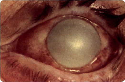 Ожог глаз: сваркой, химический ожог. Первая помощь при ожоге глаза2