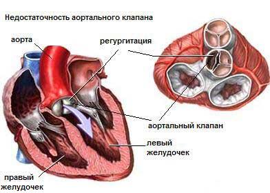 Порок клапана легочной артерии. Врожденный порок КЛА2