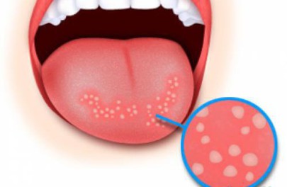 Как лечить язвы во рту?2