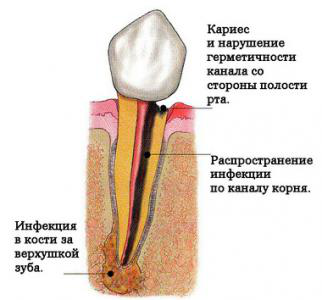 Почему болит корень зуба: причины, варианты лечения, последствия2