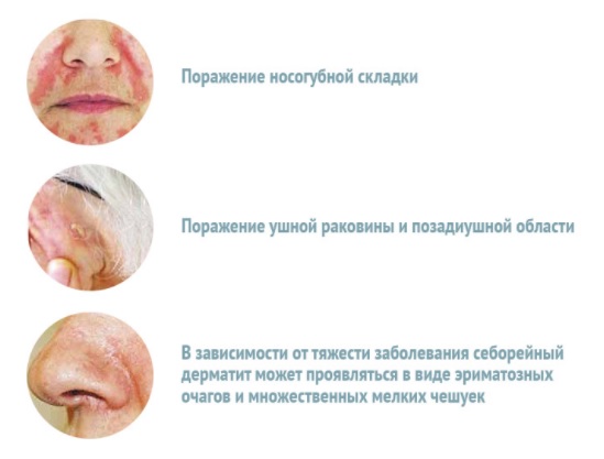 Себорейный дерматит на лице: симптомы, лечение2