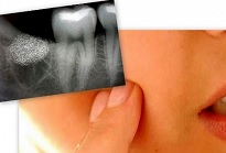 Осложнения после удаления зуба