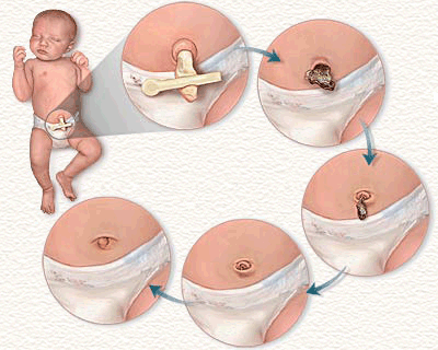 Пупочный сепсис у новорожденных: симптомы, диагностика, лечение3