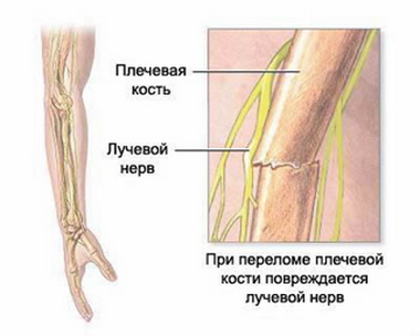 Повреждение нервов верхней конечности3