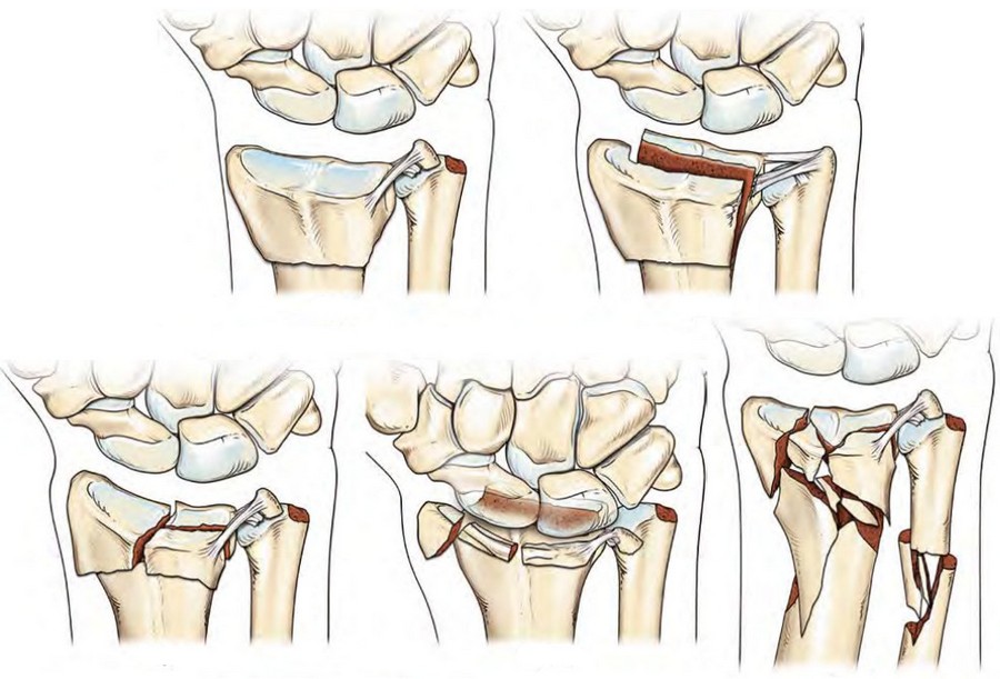 Перелом костей коленного сустава3