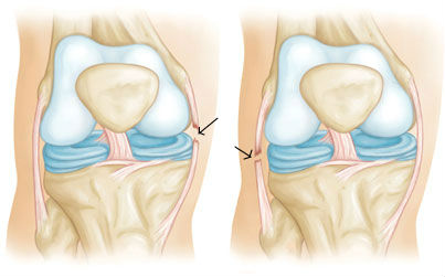 Повреждения связок коленного сустава3