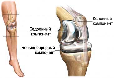 Эндопротезирование коленного сустава3