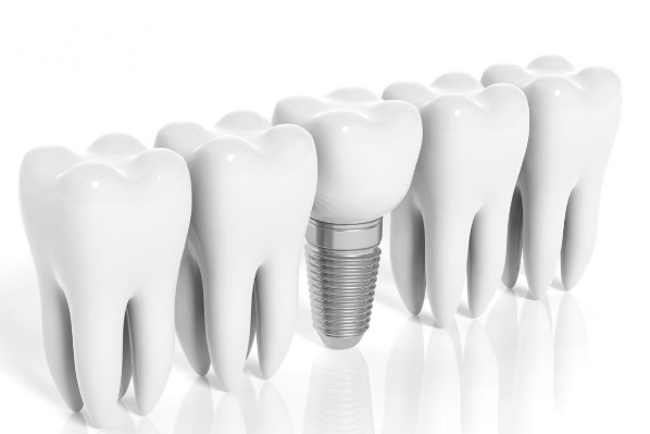 Имплантаты, соединенные с зубами3
