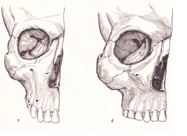 Задние отделы верхней челюсти3