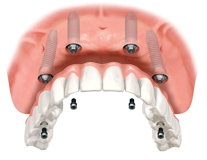 Имплантация верхней челюсти при частичном отсутствии зубов3