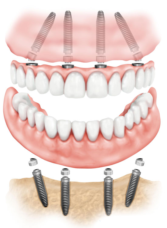 Восстановление всех зубов верхней челюсти3