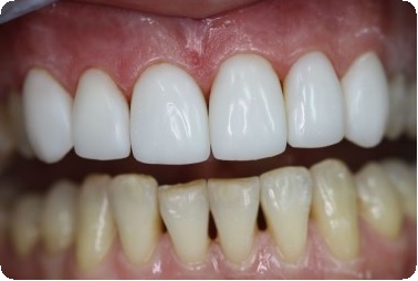 Особенности восстановления передних зубов3